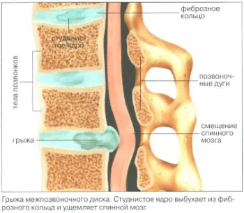 Грыжа межпозвоночного диска Грыжа межпозвоночного диска