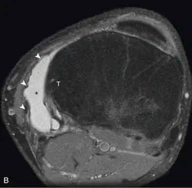 Бурсит «гусиной лапки»