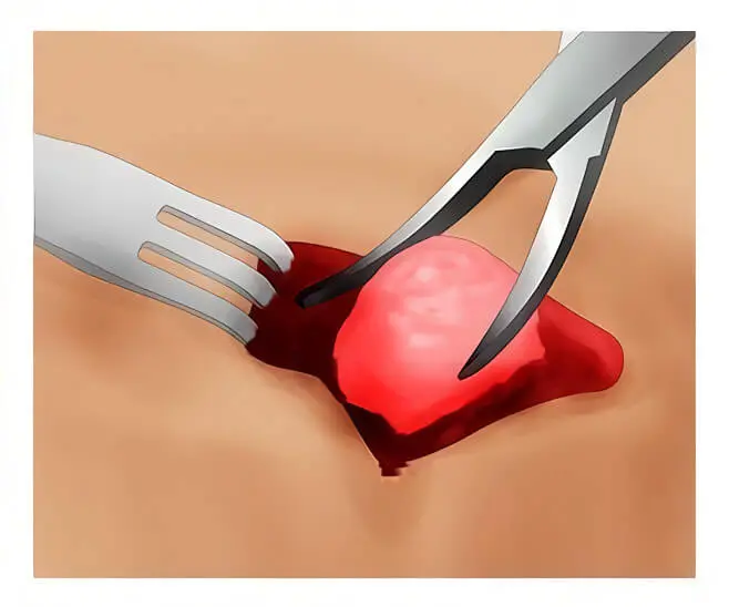 Лечение кисты Бейкера путем ее хирургического удаления Лечение кисты Бейкера путем хирургического удаления