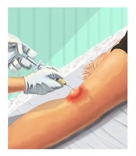 лечение кисты в колене