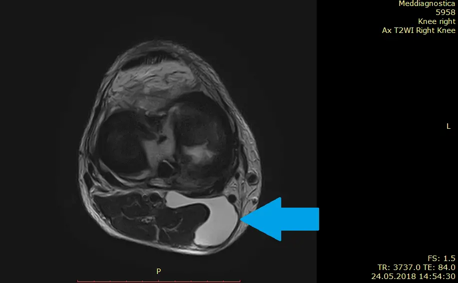 Киста Бейкера на МРТ