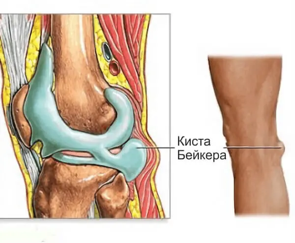 Киста Бейкера коленного сустава