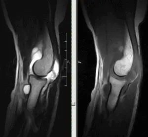 МРТ локтевого сустава МРТ локтевого сустава
