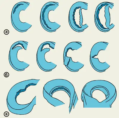 Некоторые варианты травмы и разрывов мениска травмы мениска, расслоение мениска