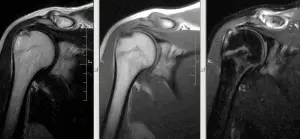 На симке МРТ плечового суглоба - розрив сухожилля надостной м'язи МРТ плеча