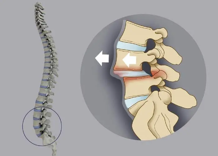 Двигательные нарушения при остеохнодрозе