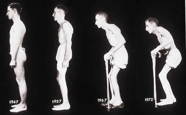 Анкилозирующий спондилоартрит (болезнь Бехтерева) Анкілозуючий спонділоартрит (хвороба Бехтерева)