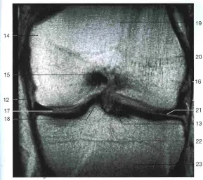 МРТ колена: мениски черного цвета под номерами 17 и 21 разрыв мениска лечение без операции