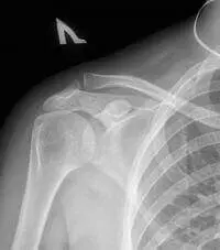 Цифровий рентген плечового суглоба Цифровий рентген плечового суглоба