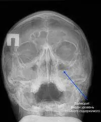 Рентгенографія придаткових пазух носа, рентген гайморових пазух носа Рентген гайморових пазух