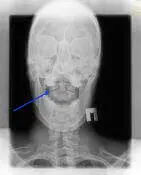 Рентгенографія суглобів голови Рентгенографія суглобів голови