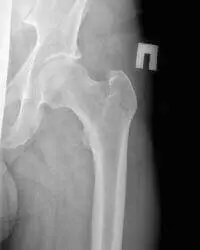 рентген кульшового суглоба