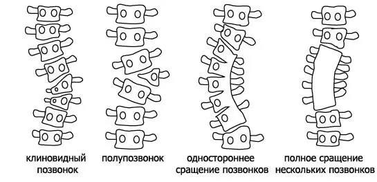 Сколиоз. Причины развития сколиоза