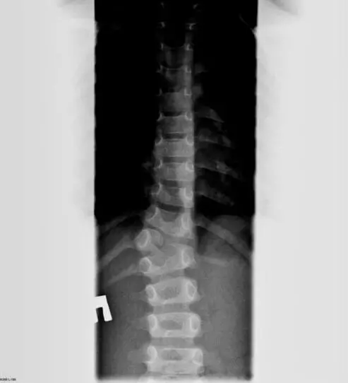 Сколиоз. Причины развития сколиоза
