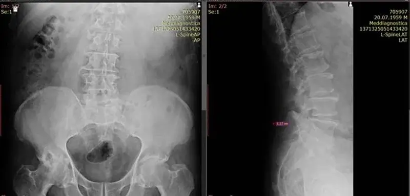 деформуючий спондильоз