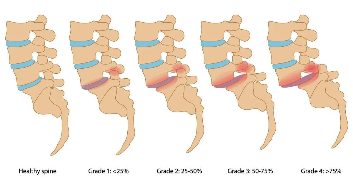 Спондилолистез позвоночника