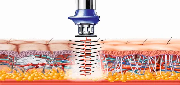 Ударно-волновая терапия (УВТ) Ударно-волновая терапия (УВТ)