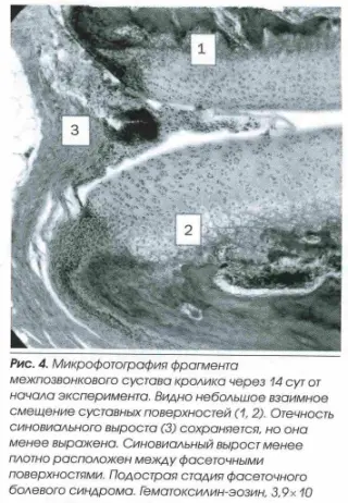 fasetochnyj sindrom4
