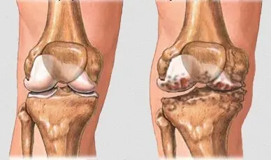 Артрит коленного сустава симптомы Артрит коленного сустава симптомы