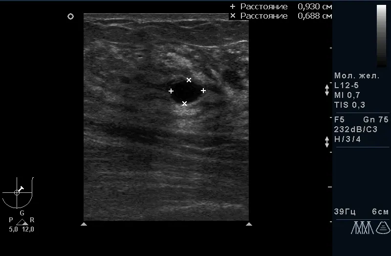 Фіброзно-кістозна мастопатія з кістозним компонентом. Фіброзно-кістозна мастопатія з кістозним компонентом.