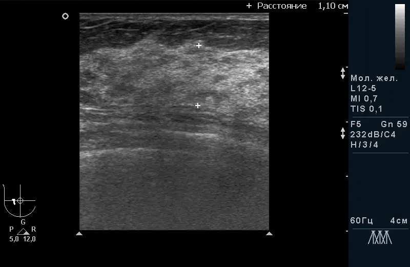 Дифузна форма мастопатії без гіперплазії і фіброзу Дифузна форма мастопатії без гіперплазії і фіброзу