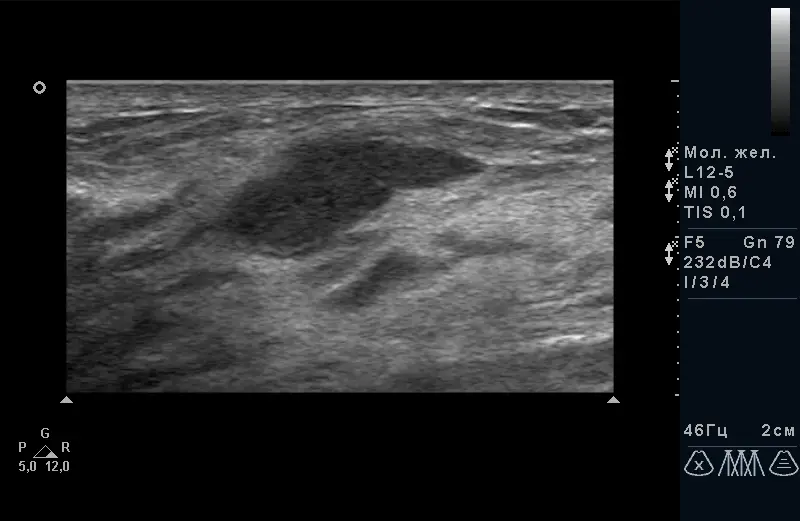 протоковая папілома протоковая папілома