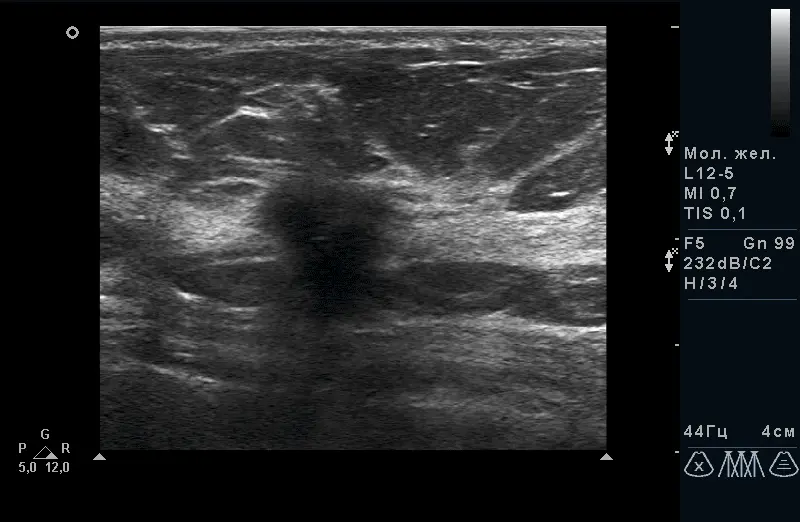 Рак молочної залози Рак молочної залози