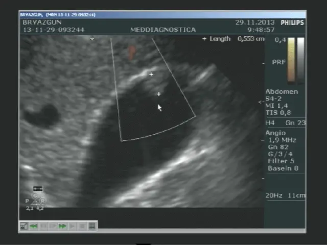 Поліп жовчного міхура Поліп жовчного міхура