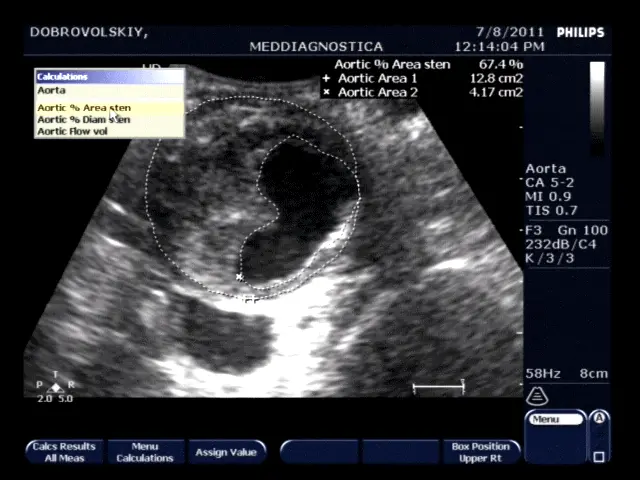 Аневрізатіческое розширення черевного відділу аорти з її пристінковим тромбозом Аневрізатіческое розширення черевного відділу аорти з її пристінковим тромбозом
