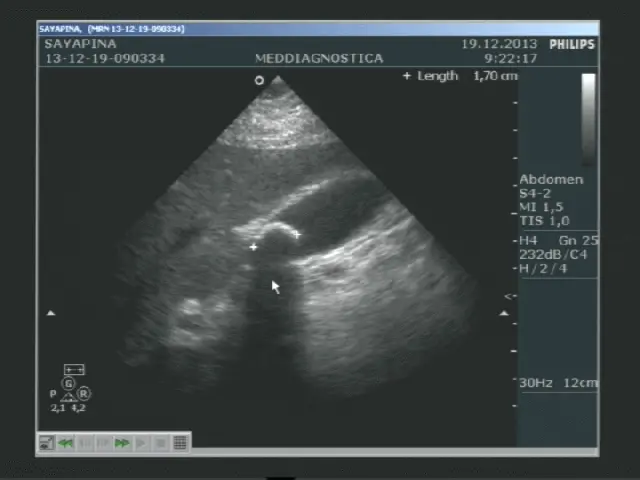 Конкремент (камінь) в жовчному міхурі. Конкремент (камінь) в жовчному міхурі