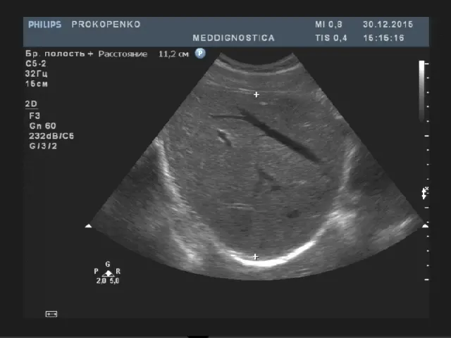 УЗ картина печінки в нормі УЗ картина печінки в нормі