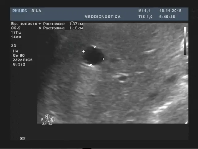 Патологічні зміни, які виявляються на УЗД Патологічні зміни, які виявляються на УЗД