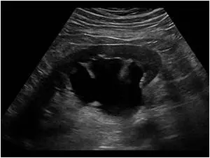 УЗ картина нирок в нормі УЗ картина нирок в нормі