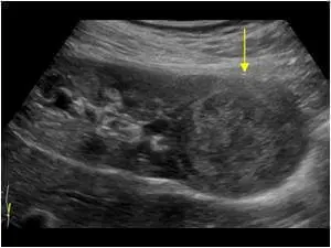 Патологічні зміни, які виявляються на УЗД Патологічні зміни, які виявляються на УЗД