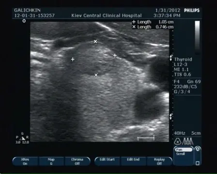 УЗД щитовидної залози УЗД щитовидної залози
