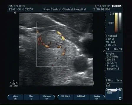 УЗД щитовидної залози УЗД щитовидної залози
