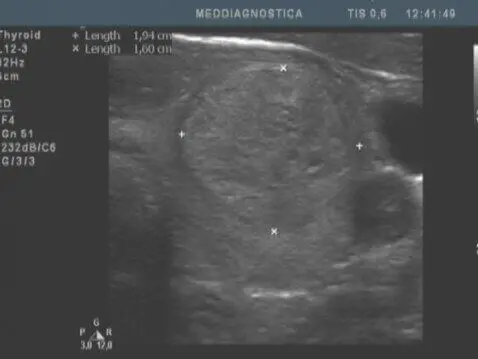 УЗД щитовидної залози УЗД щитовидної залози