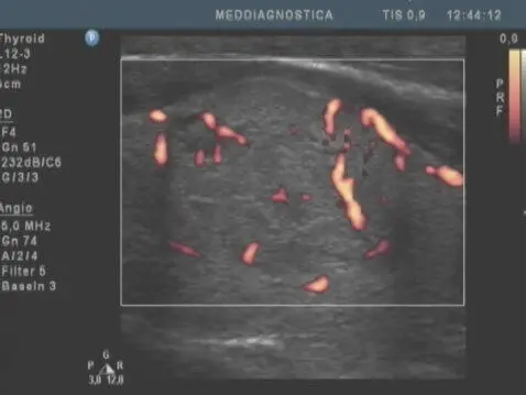 УЗД щитовидної залози УЗД щитовидної залози