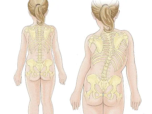 Сколиоз у детей Сколиоз у детей