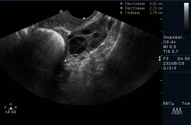 Преовуляторний фолікул з яйценосного горбком (ознака майбутньої овуляції) Преовуляторний фолікул з яйценосного горбком (ознака майбутньої овуляції)