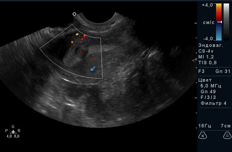 Субмукозная міома матки Субмукозная міома матки