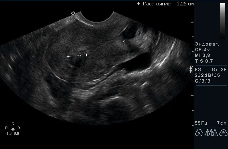 Поліп ендометрія. Вид при соногістероскопіі Поліп ендометрія. Вид при соногістероскопіі