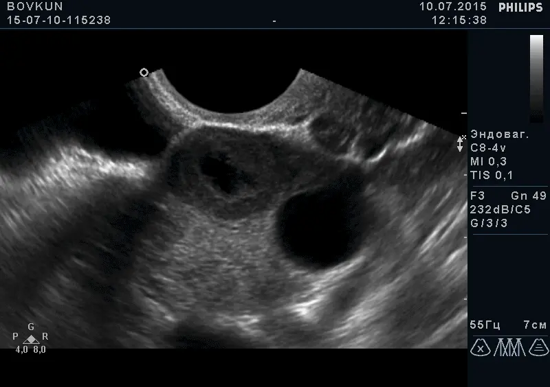 Позаматкова вагітність в ампулярном відділі маткової труби Позаматкова вагітність в ампулярном відділі маткової труби