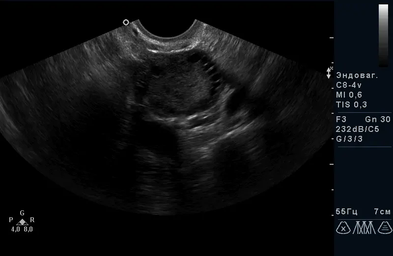 Полікістозних яєчників. Полікістозних яєчників.