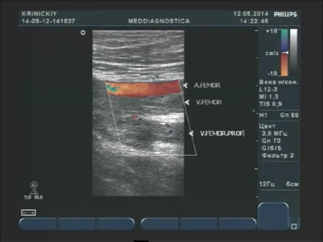 Дуплексне сканування (УЗД) вен нижніх кінцівок Дуплексне сканування (УЗД) вен нижніх кінцівок