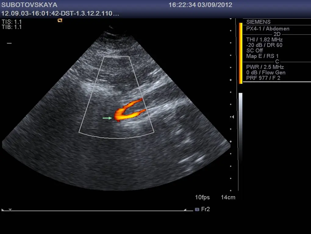 Дуплексне сканування вен нижніх кінцівок Дуплексне сканування вен нижніх кінцівок