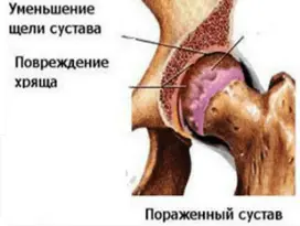 Артрит тазобедренного сустава Артрит тазобедренного сустава
