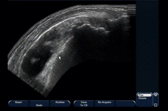 Бурсит с пролиферацией синовиальной оболочки