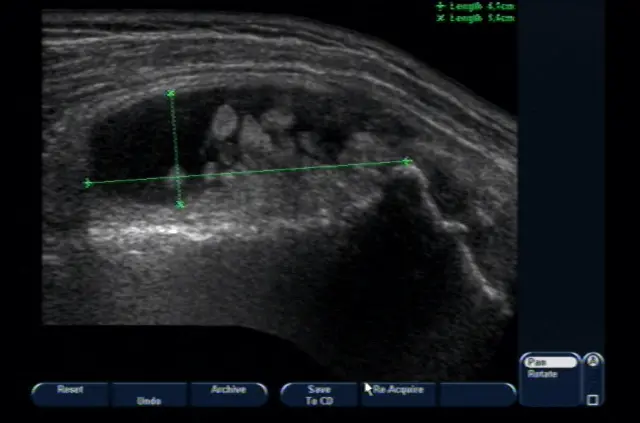 Бурсит с пролиферацией синовиальной оболочки Бурсит с пролиферацией синовиальной оболочки