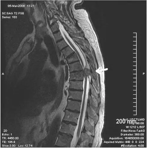 рентген грудного відділу хребта